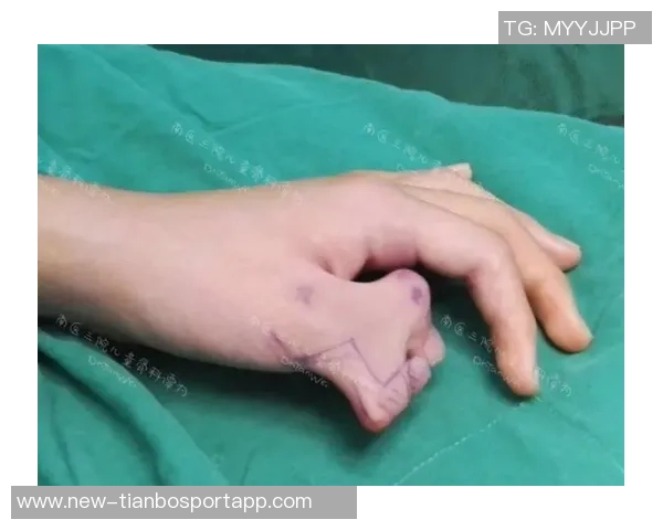 诺伊尔因手指关节囊受伤佩戴特制四指手套积极恢复状态